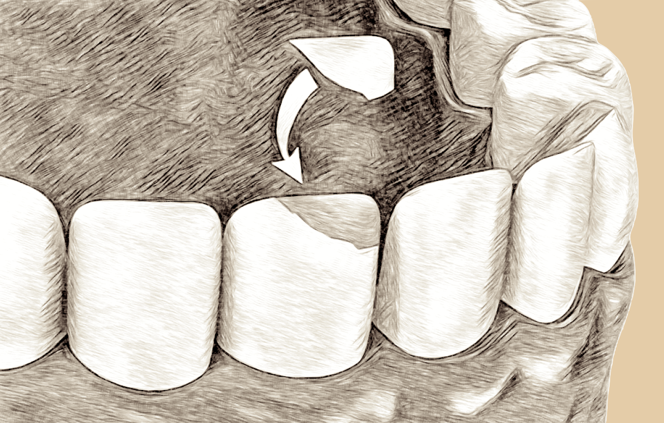 Illustration of a tooth bonding technique