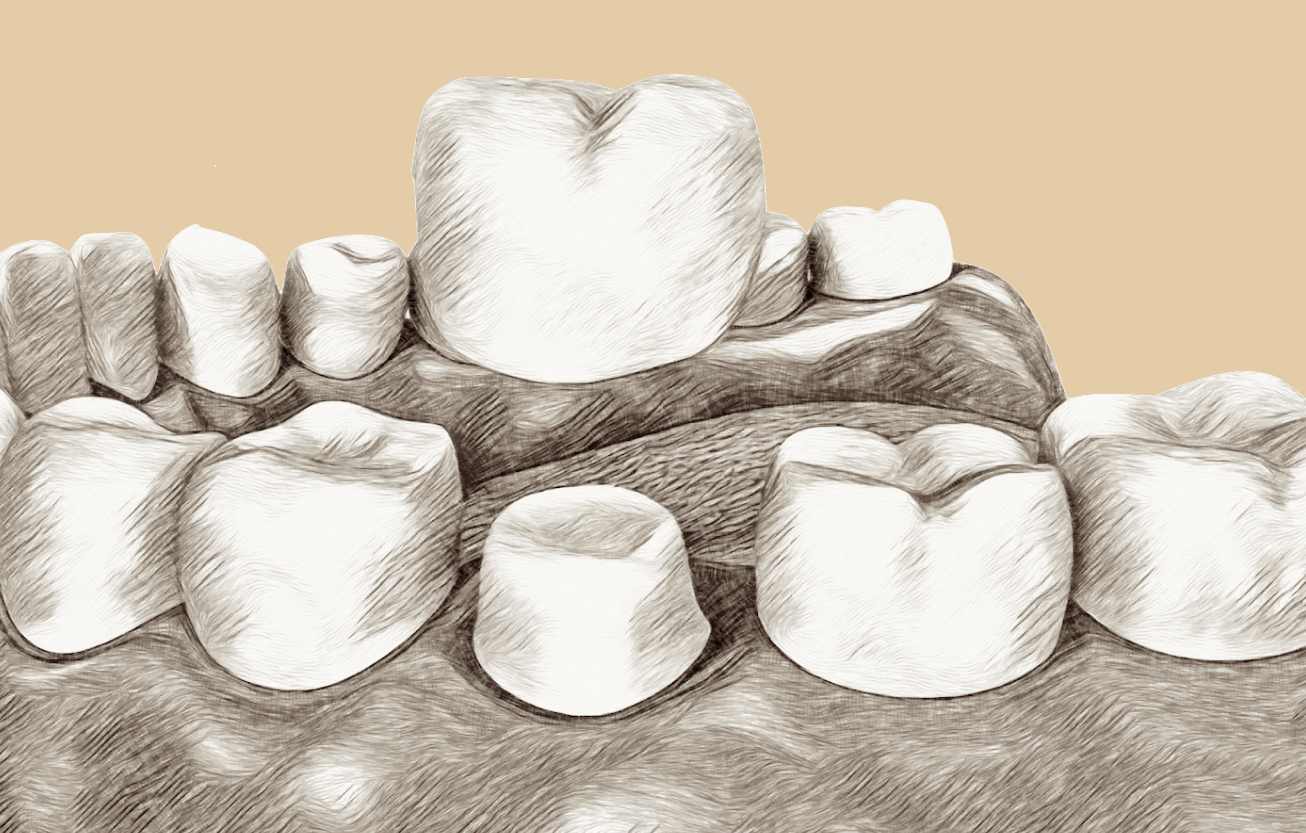 A picture of dental crown technique