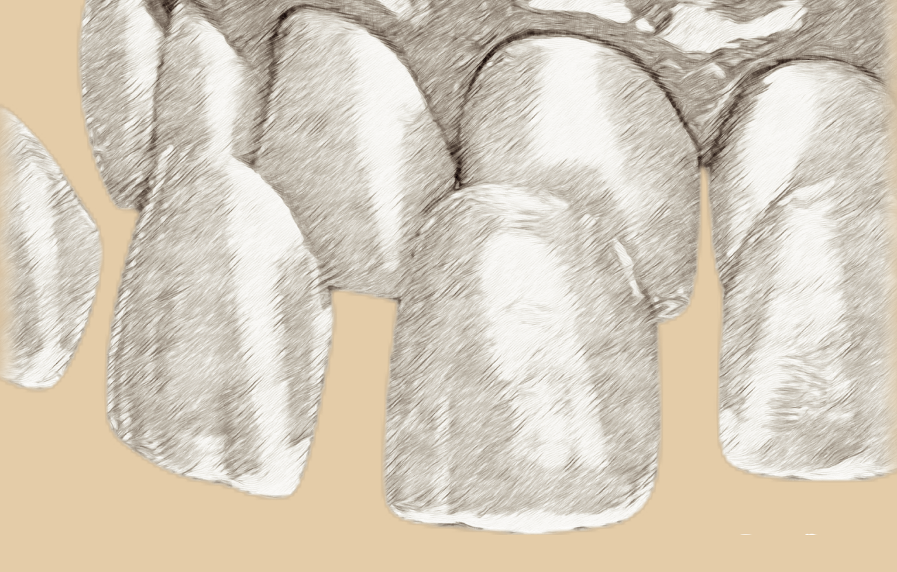 An illustration of dental veneer application
