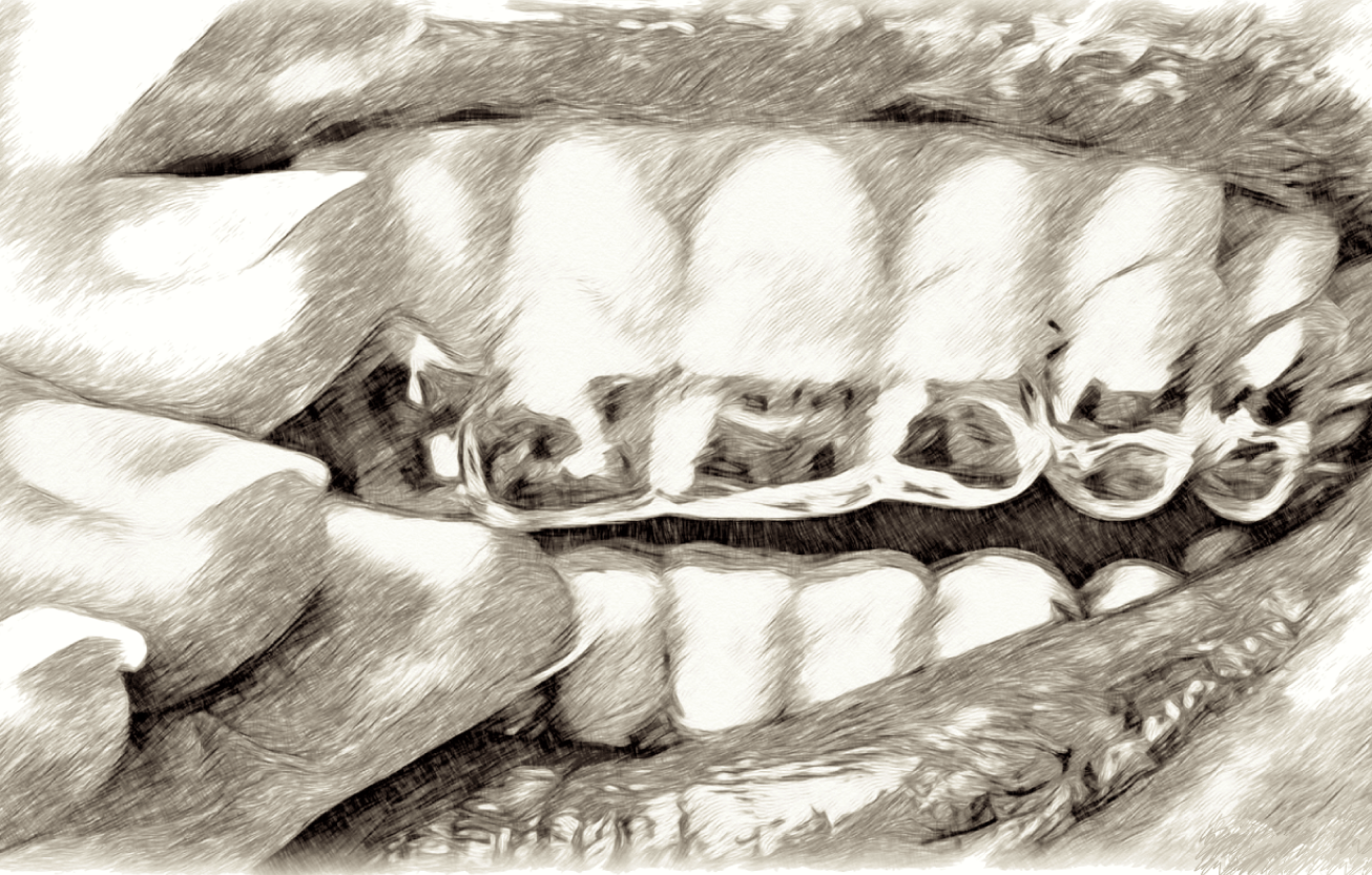A person applying a whitening tray to their teeth